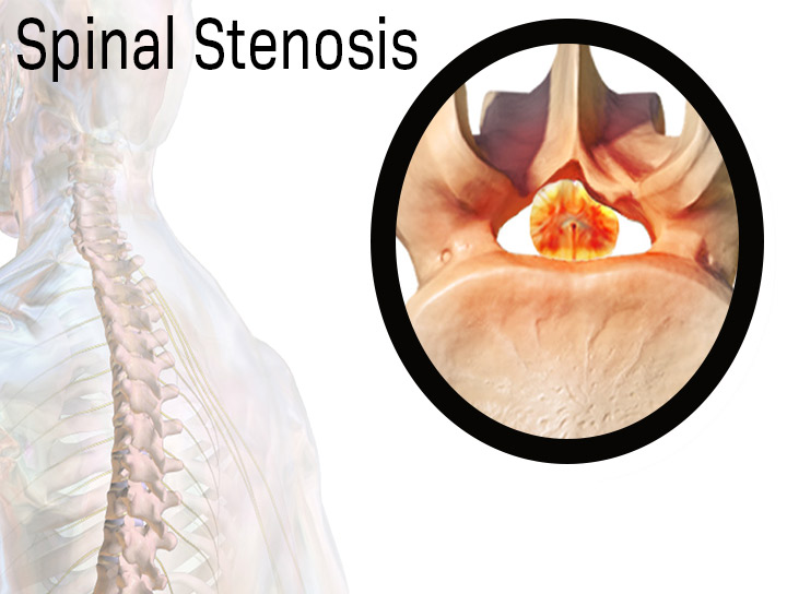 diagram showing the makeup of spinal stenosis